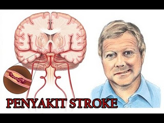 Illustration for article titled Obat Stroke Alami Paling Ampuh